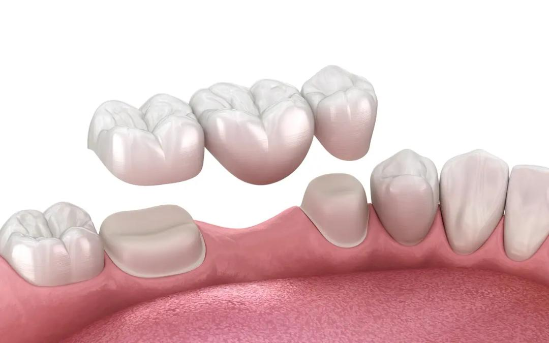 Dental Implants Wallaceburg