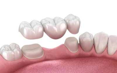 Dental Bridge vs. Implant: Which Costs More Long-Term?