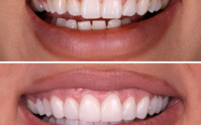 Can a Gummy Smile Be Fixed Without Undergoing Jaw Surgery?